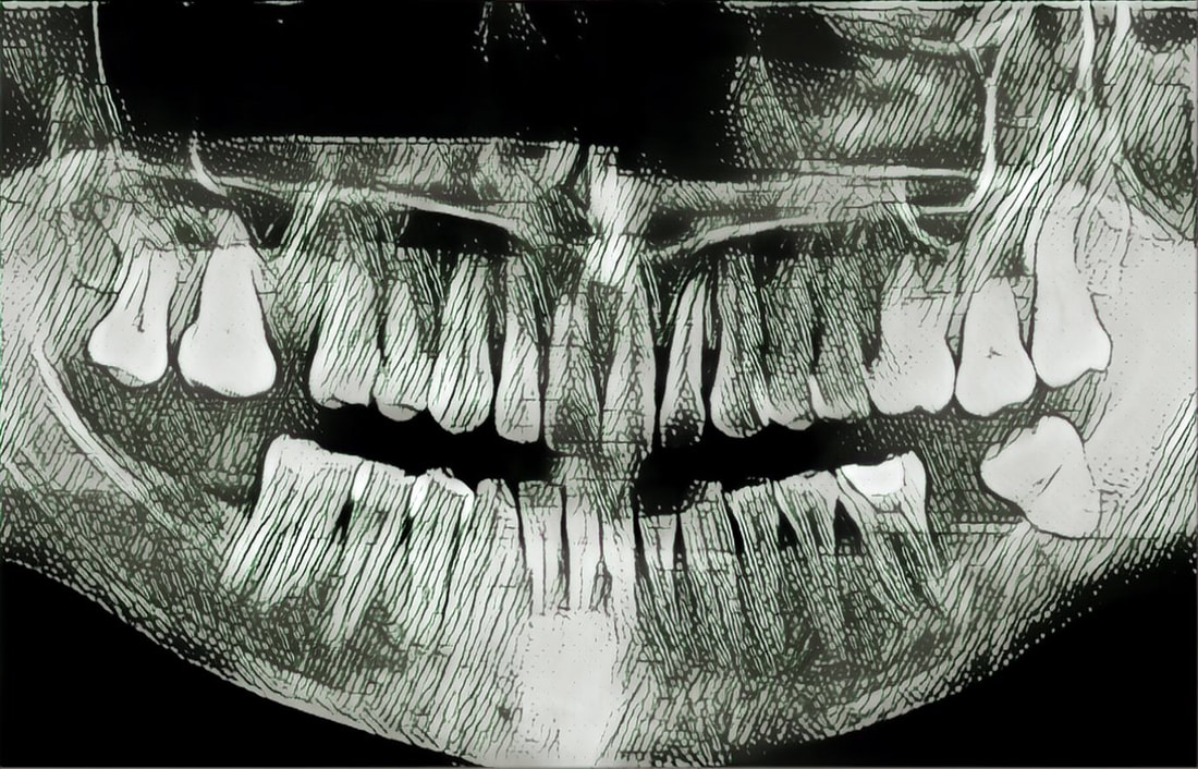 Zahnfleisch Behandlung Röntgenbild Zahnarzt Thorsten Scheele Hameln